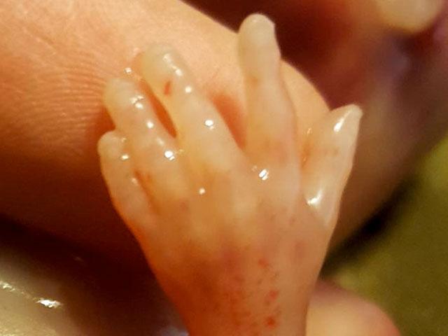 Từ bức ảnh bàn tay bé nhỏ bấu víu sự sống…